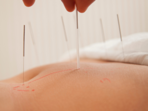 Points d&rsquo;acupuncture pour améliorer la santé au quotidien